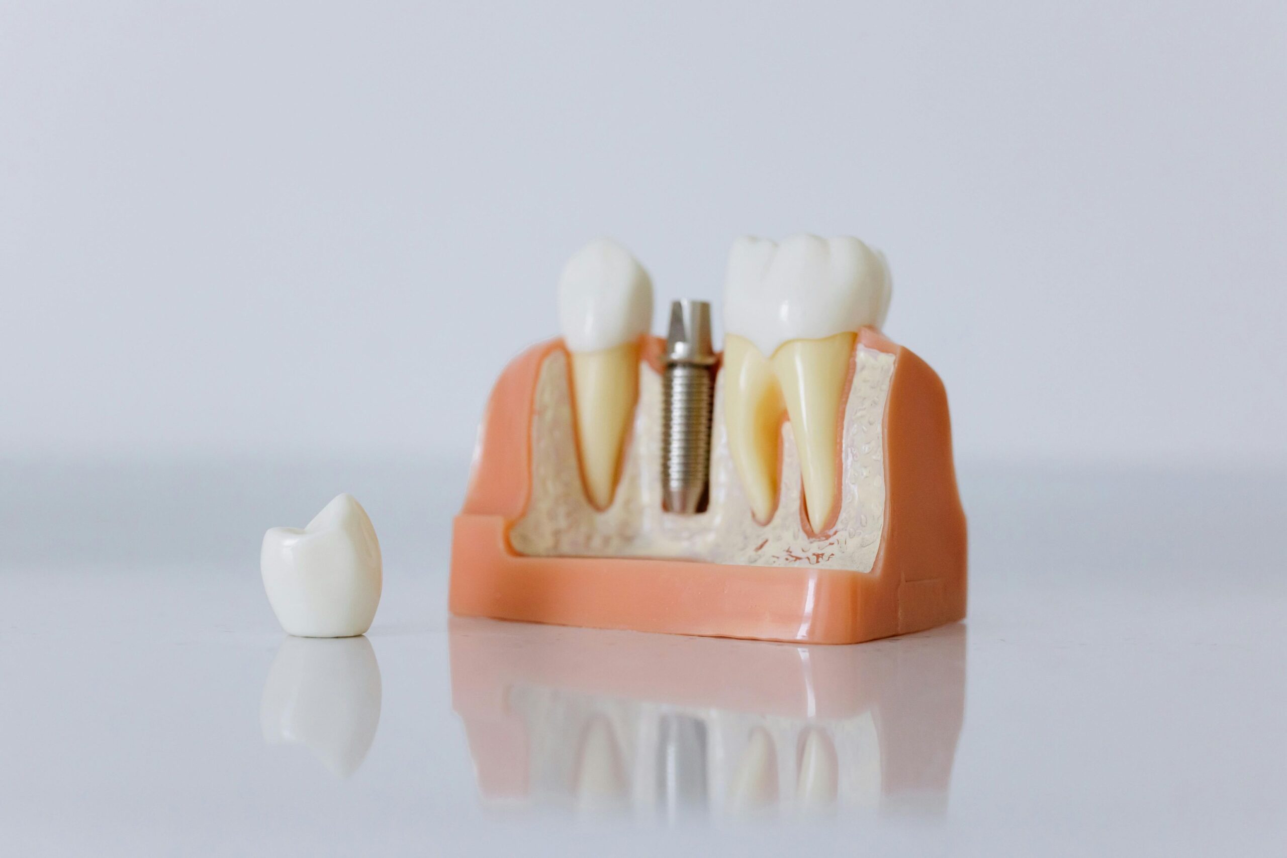 Abutment Nedir?